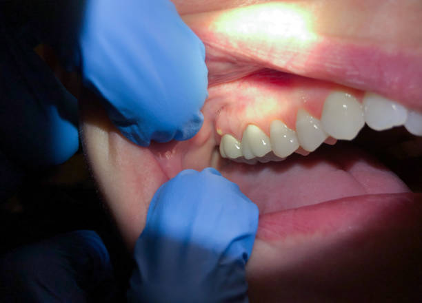 Best Emergency Dental Care for Broken or Chipped Teeth in Blue Springs, MO